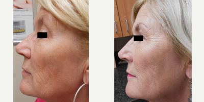 65-74 year old woman treated with Wrinkle Treatment - Before & After 2 Treatments of IPL & 1540 Fractional (Three for Me). Patient will see more results after the 3rd treatment and continue to achieve better results until 6 months after the last treatment. That will be the end result, which we will post more in time!