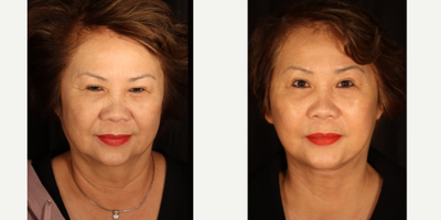 Extended Deep Plane Facelift - So many patients are afraid a facelift will make them look 'different', or 'other.' We've all seen people who look pulled and plastic, and this keeps patients with terrible self-esteem associated with aging on the sidelines.I don't do that type of surgery. This patient (only 3 weeks out) hasn't lost one iota of her face's natural character. In fact, she looks remarkably similar to the photos of herself when she was 15 years younger. Shortcut surgery does not achieve these results. Deep plane facelift takes longer and is technically more challenging than minilifts and limited SMAS procedures, but the results, even early on, speak for themselves.So excited for my patient, whose result will just get better and better from here.