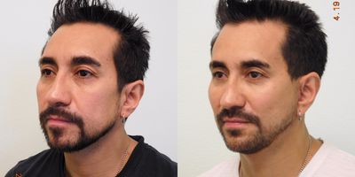 40+ year old man treated with Fat Transfer to Midface - This young man was unhappy with the volume loss in his midface/cheeks and hollowing appearance. He had used artificial filler in the past but did not prefer to have yearly injections to maintain his result (in addition to the yearly cost of product). After evaluation together we decided to perform fat transfer to his midface and cheeks. We performed the rejuvenating procedure in our Center under local anesthesia with mild oral sedation. Fat was harvested from his lower abdomen and the small incision under the belly button was closed with a single stitch. We placed approximately 10 cc's of fat (2 teaspoons equivalent) on each side via small insertion sites (no stitches required). In addition, we placed a small chin implant to help create more structure in his lower face and jawline.His results demonstrate stronger and more defined cheeks and chin (with good balance). His healing time was approximately one week before he could go back to work.