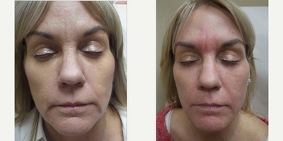 55-64 year old woman treated with Pixel Laser - Remove wrinkles