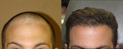 Hair restoration with FUE robotic system ARTAS - Hair restoration using ARTAS robot and FUE technology - no linear scar on the back