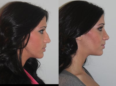 28 Year Old Female Treated for a Fractured Nose and Deviated Septum - Broken Nose and Deviated Septum Repair