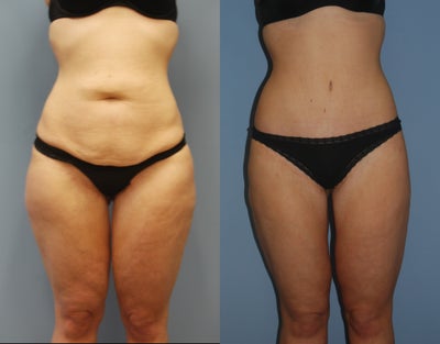 29 y/o woman with massive weight loss treated with body contouring surgery. - 
	This young woman underwent massive weight loss and developed loose skin and fat deposition along her abdomen and thighs. She underwent a lower body lift (belt lipectomy and thighplasty).

