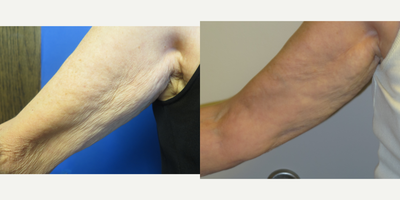 69 year old woman treated with Profound RF - This patient did not like the crepey loose skin on her arms. She had a profound RF treatment to tighten this loose skin. After photo taken 6 months later.