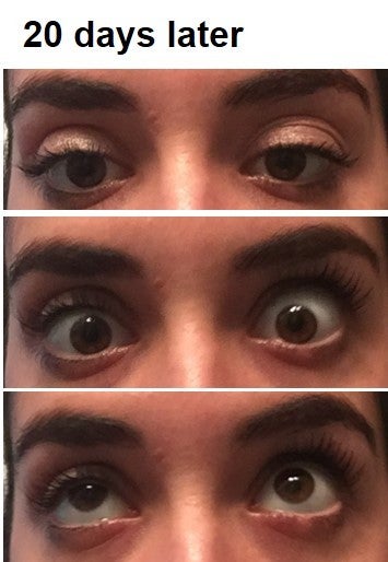 I had ptosis repair surgery on my right eye 3 weeks ago ...