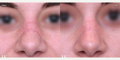 Woman treated with DeepFX, Microdermabrasion - Treatment(s):Dermabrasion, DeepFX, Vbeam