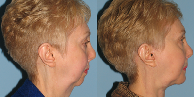62 year old woman treated with Chin Surgery - This 62 year old woman saw me to revise her bilateral cleft lip, cleft palate and nose cleft changes that were left as a residual of her childhood repair. Throughout her life she had always been so self-conscious that she had essentially no neck and a very under-projected chin. She and I talked about a simultaneous face lift, neck lift, cleft palate, cleft lip and cleft nose repair as well as a chin augmentation. Because of her midface under-projection, I also utilized cartilage under her nasal base to project her maxilla avoiding for her a maxillary advancement that I think would have been much more extensive than she wanted. Seen here this 62 year old is now 8 months follow up. She had bilateral forked flaps in order to give nasal base augmentation. I borrowed retro-auricular cartilage from the incision of the face lift and instilled it into her nasal base and nose tip in order to give better tip projection and I revised her ala and her rhinoplasty. She had submental incision approach for a silicone chin augmentation and then had a face and neck lift in a single procedure.When her dressings were removed one day post op, the patients mother who is 89 years old was so delighted to see that her daughter finally had a cervical mental angle and a neck contour that she had not had throughout her life. The patient was absolutely delighted and has had confidence that is soaring!