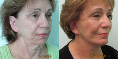 60+ year old woman treated with Neck Lift and Chin Augmentation - This energetic woman presented to our Center with the desire for improvement in her sagging neck and jawline. She mentioned that for her entire life she was not pleased with the lack of chin strength. We discussed how patients with less structure (ie jawbone and chin size) tend to have their neck and jawline tissue fall faster due to the lack of support to hold up the falling muscles and skin. We decided to add an extended anatomic silicone chin implant which naturally increased both her projection and width in keeping with the natural shape she was born with. This implant did not require any additional incisions since it was placed via the small incision under her chin that was used for the central neck refinement.The patient did not want to be put to sleep for the procedures due to her concerns over general anesthesia and associated risks. She was administered a low dose of oral valium 45 minutes before her treatment, and they were performed under local anesthesia in the comfort of our Center (no general or IV sedation used - our typical Center protocol).Most of her sutures were removed after one week, and she was able to return to her socialization events and physical activity in 2 weeks.