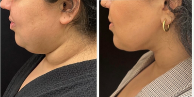25-34 year old woman treated with FaceTite - Buccal Fat, chin and neck liposculpting, facetite
