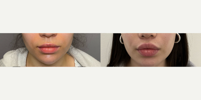 35-44 year old woman treated with Lip Lift, Lip Fillers - Lip lift surgery and fillers.