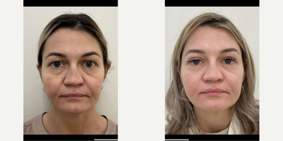 45-54 year old woman treated with Eyelid Surgery, Dermal Fillers, Dysport, Restylane - Upper Blepharoplasty + Fat Transposition, Lower Blepharoplasty + Skin Pinch.Dysport forehead, Glabella and crow's feet.Under eye Restylane filler.