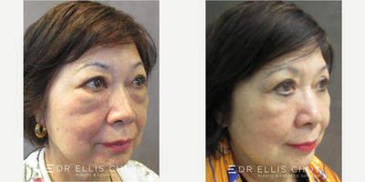 65-74 year old woman treated with Asian Eyelid Surgery - Upper and Lower Blepharoplasty for natural periorbital rejuvenation