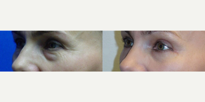 Woman treated with Eyelid Surgery - Woman treated with Eyelid Surgery (upper and lower blepharopalsty) and endoscopic brow lift, shown 2 months post op.