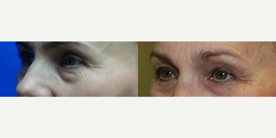 Woman treated with Eyelid Surgery - Woman treated with Eyelid Surgery (upper and lower blepharopalsty) and endoscopic brow lift, shown 17 years post op.