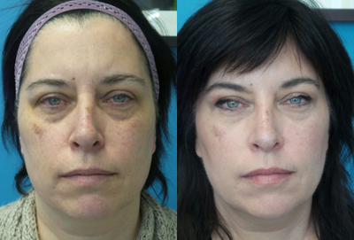 45-54 year old woman treated with Liquid Facelift - This patient was concerned with looking tired. She was treated with Restylane tear trough, Radiesse, and Botox.