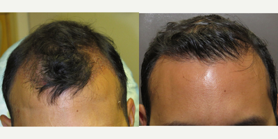 35-44 year old man treated with Hair Transplant - 35 yo male ARTAS robotic hair restoration 2500 grafts