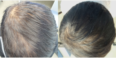45-54 year old woman treated with PRP for Hair Loss - This patient was concerned with a patch if thinning hair. She was treated with platelet rich fibrin.