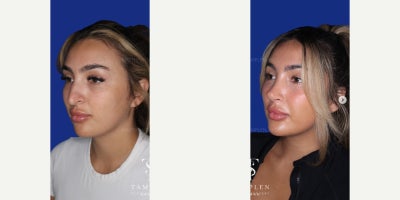 25-34 year old woman treated with Rhinoplasty - 25-34 year old woman treated with Rhinoplasty
