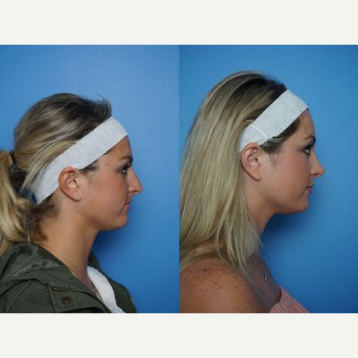 18-24 year old woman treated with Rhinoplasty - Combination of cosmetic and functional surgery. The bridge is nicely reduced, the tip is refined and the whole nose is straighter