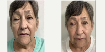 75 and up year old woman treated with Dermal Fillers, CO2 Laser, Cheek Fillers, Chin Filler, Voluma, Radiesse, Liquid Facelift - patient wanted her overall appearance to look better never had taken care of her skin a day in her life, did not want surgery. did a liquid face lift