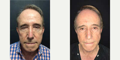 Man treated with Mini Facelift, Eyelid Surgery - Man treated with Mini Facelift, Eyelid Surgery- 2 months post-op