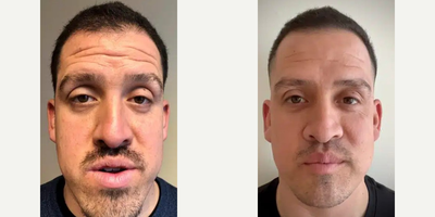 Man treated with Jaw Surgery - Man treated with Jaw Surgery