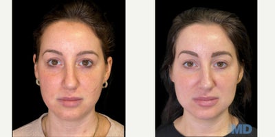 35-44 year old woman treated with IPL - This lovely patient received 2 IPL/Photofacials to address her skin texture and tone.