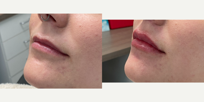 18-24 year old woman treated with Restylane Kysse - The doctor added volume and enhanced the shape of this 24-year-old patients lips with Restylane Kysse.