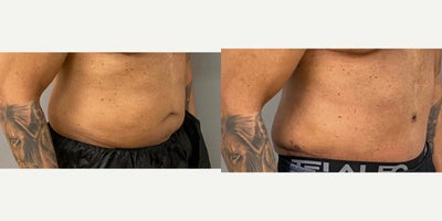 55-64 year old man treated with Male Tummy Tuck - 59 yo male s/p abdominoplasty performed under general anesthesia in our on site AAAA certified operating room suite.