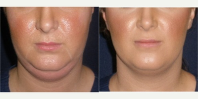 25-34 year old woman treated with Kybella - Results 2 weeks after first treatment session