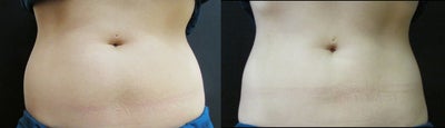 Vanquish Abdomen - Loss of 4 cm to waistline after 4 Vanquish Treatments.