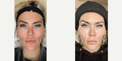 25-34 year old woman treated with Chin Filler - Our patient has noticed her under eyes appearing hollow due to aging and volume loss. She also wanted a bit of facial sculpting to fine tune her facial features. Using filler, we were able to liven her eyes up leaving them more refreshed and rejuvenated.To go the extra mile, we added the smallest amount of filler to her brow area to accentuate her eyes even more- leaving them looking more awake. As she naturally has great structure, we only gave her slight enhancements to her chin and softened the nasolabial folds.By diligently injecting filler to her chin, we created balance among her features as well as crafting that beautiful heart shaped look.