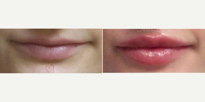 25-34 year old woman treated with Juvederm, Lip Fillers, Volbella, Restylane Kysse - Lip augmentation with hyaluronic acid filler (Juvederm, Vollure, Volbella, Voluma, Restylane or Belotero) for balanced natural look & pout