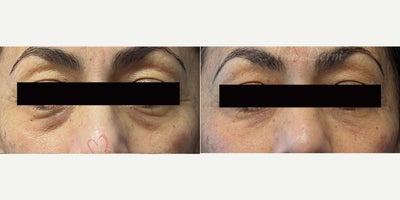 45-54 year old woman treated with Juvederm, Volbella, Voluma, Restylane - 4D Under Eye Lift - Treatment of dark circles & bags under eyes and cheek restoration with Belotero, Restylane, Volbella and Voluma
