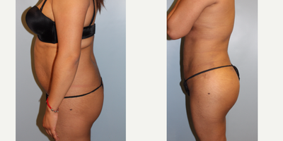 25-34 year old woman treated with Brazilian Butt Lift - BBL performed by Dr. Bryson Richards