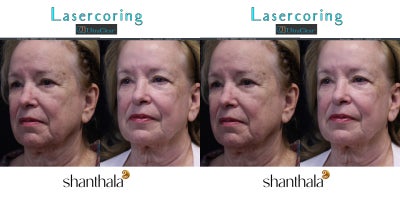 UltraClear Laser-Coring by Dr. Shanthala - 74 yrs old patient after Full face & Neck Laser-Coring with UltraClear laser resulted in improving skin quality, dyschromia, laxity.