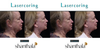 UltraClear Laser-Coring by Dr. Shanthala - 74 yrs old patient after Full face & Neck Laser-Coring with UltraClear laser resulted in improving skin quality, dyschromia, laxity.