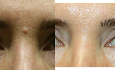 Mole Removal - 
	Mole Removal
