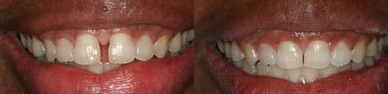 Invisalign Correction - Smile enhancement with Invisalign.