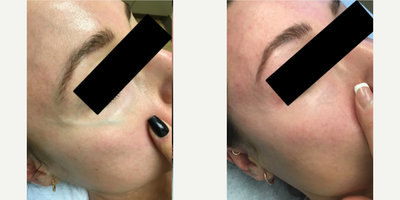 25-34 year old woman treated with Asclera for Face Sclerotherapy - Before & After only 2 sessions of face sclerotherapy.