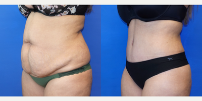 34 year old woman treated with Liposuction - 34 year old woman treated with Liposuction for a narrower and more graceful waistline as well as Tummy Tuck to remove unwanted extra skin. Patient had children and wanted to restore her curvier shape. She was unhappy with her shape after pregnancy.
