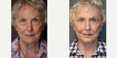 Extremely Mini Jawline Lift - Minimally invasive, limited incision quick lift of the jawline.