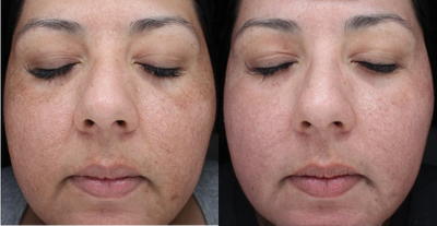 Woman in her 30's treated with Laser Treatment (Fractora RF) - Woman in her 30's treated with Laser Treatment (Fractora RF), 2 weeks post-op