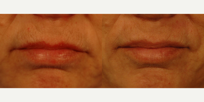Los Angeles Fractional Resurfacing for Lip Lines - Before and after photos of our Los Angeles patient for Profractional laser resurfacing before and after only one visit.