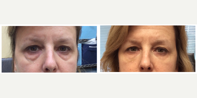 45-54 year old woman treated with Belotero - Belotero under eyes and Sclerotherapy to vein under eyes.