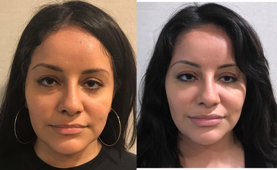 25-34 year old woman treated with Restylane - My 27-year-old patient 2 weeks after Belotero filler to the under eye, Restylane Lyft to the cheeks, and Restylane to the lips. She has received many compliments at work and they arent sure why she looks better.