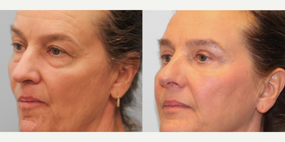 55-64 year old woman treated with Rhinoplasty - This woman in her early sixties came to see Dr. Howell for a blepharoplasty and rhinoplasty. She lost a significant amount of weight and had concerns about the loose skin around her eyes. After discussing with Dr. Howell, she chose to go with a closed rhinoplasty and upper and lower blepharoplasty. Since her surgery, she feels like she looks much more rested and refreshed and has been very happy with her results. She is pictured before and three months post-op.
