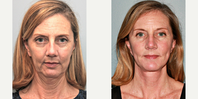 46 year old woman treated with Lifestyle Lift - Prior to surgery, this 46 year old woman looked much older than her true age. Now after a LiteLift, modified facelift, chin augmentation, and neck liposuction. Her surgeries have made a dramatic improvement in the overall proportion of her face and contour of her neckline. After photos taken 2 most post-surgery.