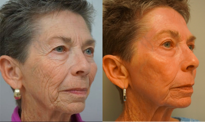 65-74 year old woman treated with Renuvion - Full face J Plasma (Renuvion) skin resurfacing