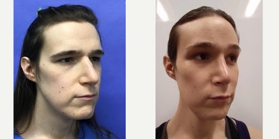 35-44 year old transgender woman treated with Brow Lift, Forehead Reduction, Septoplasty, Cheek Augmentation, Adam's Apple Reduc - 35 to 44 year-old female patient is 1 year post-op from Facial Feminization surgery. Her procedures included: Forehead Lift, Hairline Lowering, Supra Orbital Bone Reduction and Contouring, Septorhinoplasty (closed) with Cartilage Grafts and Weirs, Cheek Implants (small combined), Chin Reduction and Contour, Thyroid Cartilage Shave, 300 Micrografts to the Frontotemporal Recessions, Lip Lift, Fascia to Lips, Soft Tissue to Nasolabial Folds, Lower Eyelid Blepharoplasty (TC), and 1 cc Juvederm to Facial Rhytids.